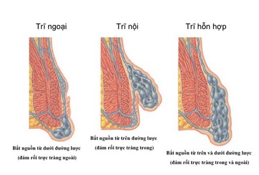 Trĩ vòng